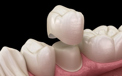 Animated dental crown being placed on tooth