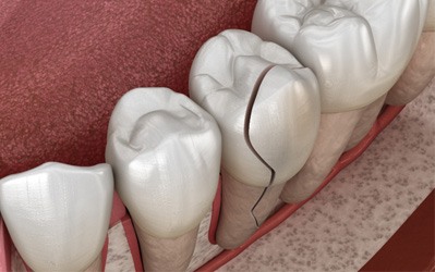Cracked tooth needing a dental crown 