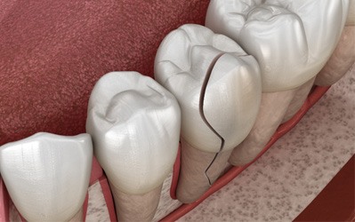 Cracked tooth needing a dental crown