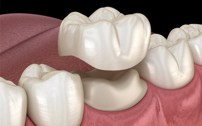 Digital image of a dental crown being put into place