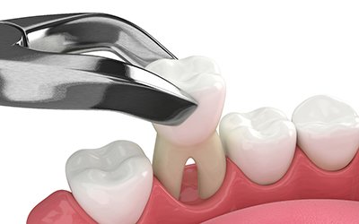 Illustration of a tooth extraction in Forest Park, OH