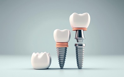 an example of the parts of dental implants