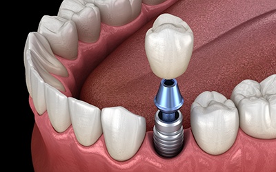 a computer illustration showing an implant crown