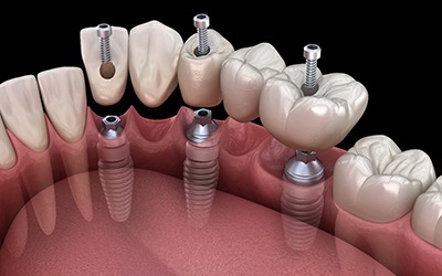 a computer illustration showing an implant bridge