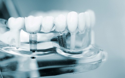 a model of a mouth showing how dental implants work