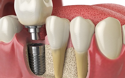 a graphic illustration showing a dental implant fused with a jawbone