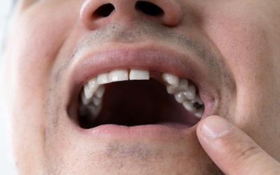 a man pointing to a missing tooth