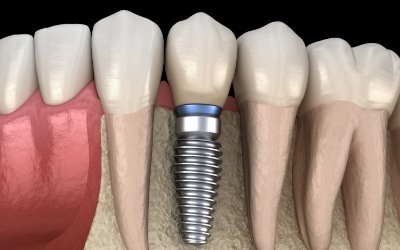 Animated dental implant supported replacement tooth