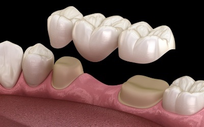 Animated smile during dental bridge placement