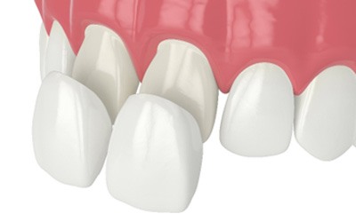 Illustration of veneers being placed on two front teeth