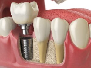 Digital rendering of dental implant. 